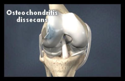 A 3D model of a knee joint showing the area being repaired in an osteochondritis dissecans repair.